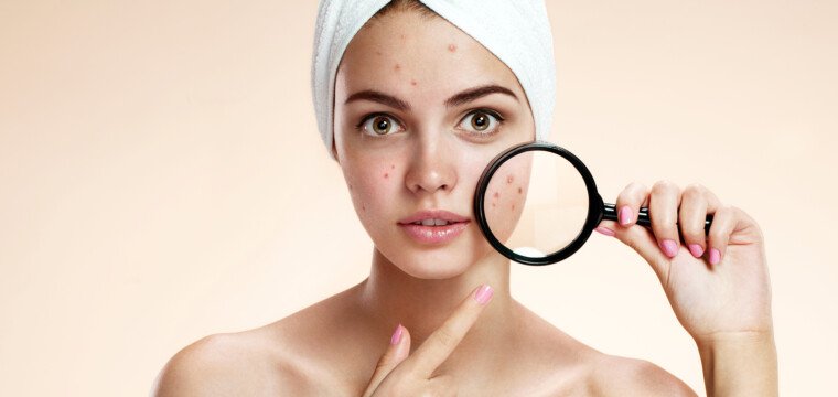 A acne adulta cresce e se agrava durante a pandemia