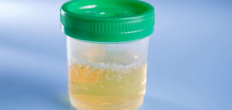 Espuma e bolhas na urina podem sinalizar alterações nos rins